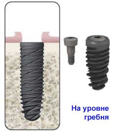 Установка имплантата на уровне гребня