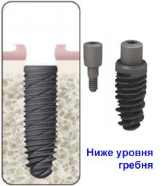 Установка имплантата ниже уровня гребня